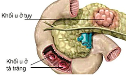 Câu hỏi thường gặp liên quan đến hội chứng Zollinger-Ellison
