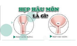 Câu hỏi thường gặp liên quan đến hẹp hậu môn ở trẻ em