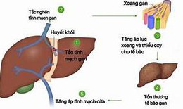 Các thuốc điều trị Hội chứng Budd-Chiari
