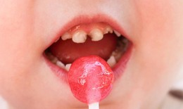 Răng sữa: Tạm thời hay &#39;nền tảng quan trọng&#39; m&#224; mẹ chưa biết?