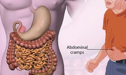 Câu hỏi thường gặp liên quan đến hội chứng Dumping