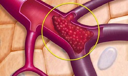 Câu hỏi thường gặp trong bệnh huyết khối