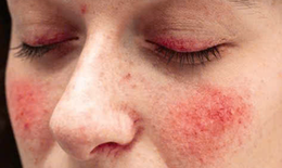 Câu hỏi thường gặp về hội chứng Carcinoid
