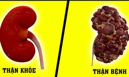 4 thói quen gây hỏng thận nhanh nhất cần thay đổi ngay