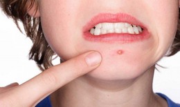 Điều trị mụn như thế n&#224;o l&#224; đ&#250;ng c&#225;ch v&#224; bao l&#226;u sẽ c&#243; hiệu quả?