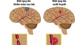 Có nên dùng An cung ngưu hoàng hoàn để phòng và điều trị đột quỵ?