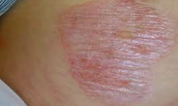 Câu hỏi thường gặp liên quan đến bệnh lichen xơ hóa