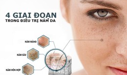 Chữa nám da ở mức độ trung bình