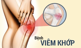 Viêm khớp: Nguyên nhân, triệu chứng, cách điều trị và phòng ngừa