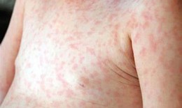 Xử lý triệt để các ổ dịch sốt xuất huyết ngay từ khi xuất hiện