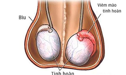 Những câu hỏi thường gặp về bệnh viêm mào tinh hoàn