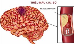 Cách phòng ngừa cục máu đông