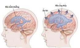 C&#226;u hỏi thường gặp li&#234;n quan đến bệnh gi&#227;n n&#227;o thất