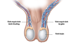 Câu hỏi thường gặp liên quan đến bệnh giãn tĩnh mạch thừng tinh