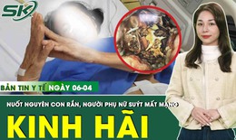 Bản tin Y tế 6/4: Nuốt nguyên con rắn, người phụ nữ tắc ruột vì hàng trăm mảnh xương
