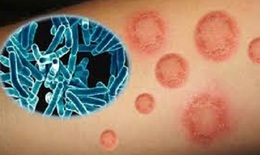 Lao da và mô dưới da: Nguyên nhân, biểu hiện, cách điều trị và phòng bệnh