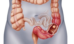 Liệt ruột: Nguyên nhân, biểu hiện, cách điều trị và phòng bệnh