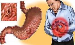 Loét dạ dày tá tràng: Nguyên nhân, biểu hiện, cách điều trị và phòng bệnh