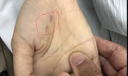 Sở Y tế Hoà Bình thông tin về ca bệnh dại tử vong 