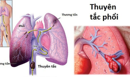 Câu hỏi thường gặp liên quan đến bệnh thuyên tắc phổi