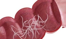 Câu hỏi thường gặp liên quan đến bệnh giun kim