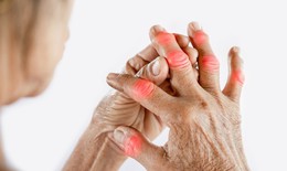 Biểu hiện cảnh báo khởi phát bệnh gút
