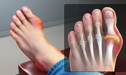 Người có nguy cơ cao mắc bệnh gout cần lưu ý gì?