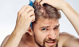 Rụng t&#243;c ở nam giới v&#224; giải ph&#225;p khắc phục