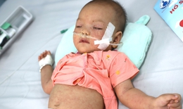 Bệnh tay ch&#226;n miệng v&#224;o m&#249;a, giải ph&#225;p n&#224;o ‘k&#236;m h&#227;m’?