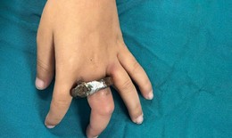 Vòng khóa siết ngón tay bé trai, gia đình cưa cửa mang đến viện