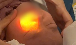 Cảnh báo từ bệnh viện: Trẻ 4 tuổi phải cấp cứu do cồn rửa tay bắn vào mắt