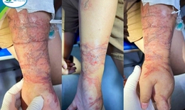 Bé gái phải cấp cứu vì tổn thương da chằng chịt do tiếp xúc với sứa khi tắm biển