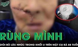 Rùng mình: Giòi bò lúc nhúc trong khối u trên mặt cụ bà 88 tuổi ở Quảng Nam