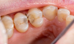 Những dấu hiệu cảnh báo cơ thể thiếu canxi người Việt dễ bỏ qua