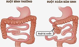 Đau bụng cảnh giác với xoắn ruột cần nhập viện khẩn cấp