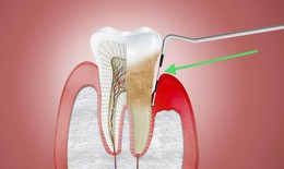 Nói không với thói quen xấu, bảo vệ sức khỏe răng miệng