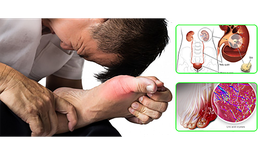 Bệnh gout ảnh hưởng thế nào đến tim, thận?