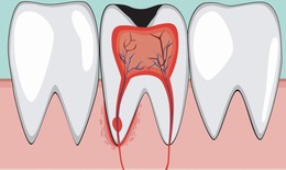 Vi&#234;m tủy răng ở trẻ c&#243; biểu hiện g&#236;, hệ lụy ra sao?