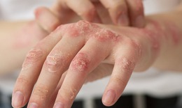 5 bệnh về da nguy hiểm thường gặp sau bão, lũ lụt