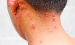 Cách chăm sóc bệnh nhân mắc zona thần kinh mau khỏi