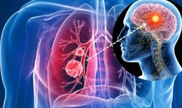 Vì sao ung thư phổi thường di căn lên não?