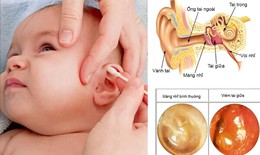 Trẻ dưới 2 tuổi bị viêm tai giữa cấp mủ: Cha mẹ cần làm gì để cải thiện nhanh triệu chứng?
