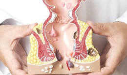 Cách để hạn chế bệnh trĩ phát triển