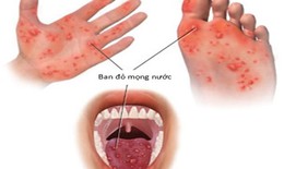 Nên chữa bệnh tay chân miệng ở nhà hay đến cơ sở y tế?
