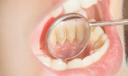 Cách nhận biết cao răng đang tích tụ