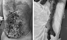 Cảnh báo: Tổn thương nặng do tự đắp thuốc chữa bỏng tại nhà