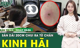 Bản tin Y tế 5/6: Kinh hãi giun sán chui ra từ chân 2 anh em do ăn món khoái khẩu