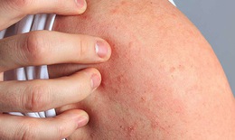 Dị ứng thức ăn có thể gây sốc phản vệ nguy kịch