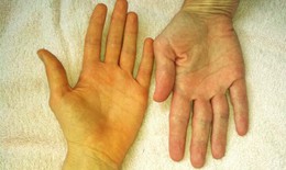 Cụ bà tắc ruột do sỏi túi mật: yếu tố nguy cơ nào gây sỏi túi mật?