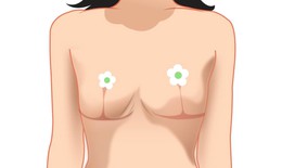 Biến chứng thẩm mỹ ngực sa trễ